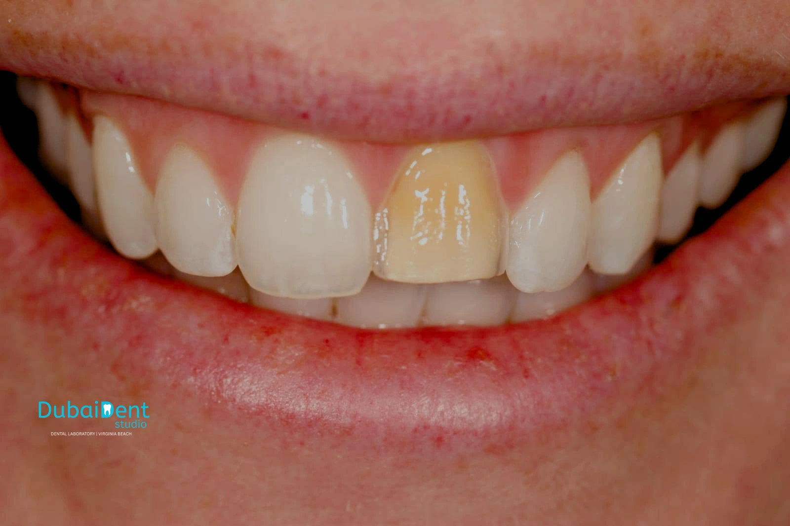 Case 1 GH before custom shade matching