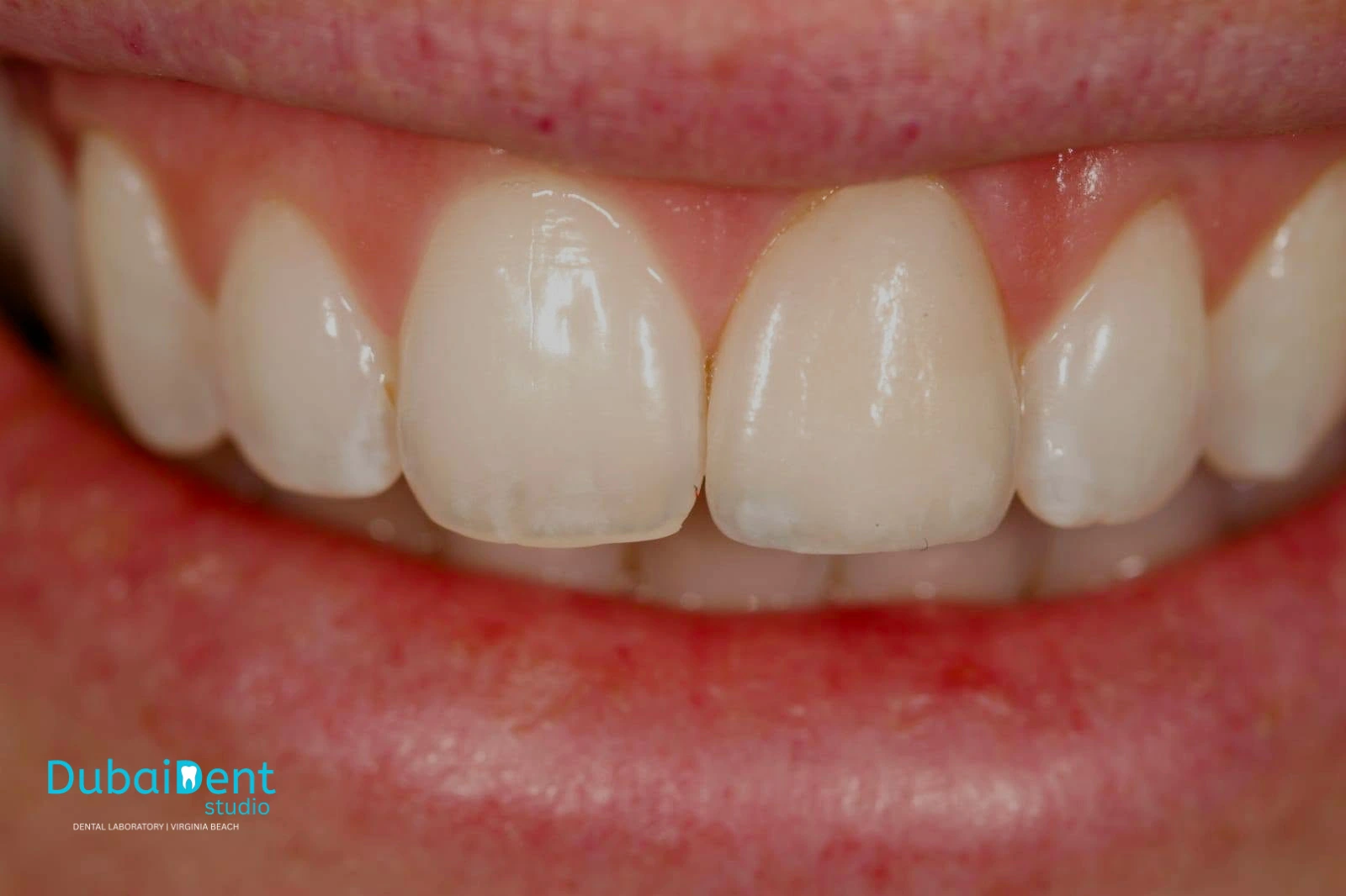 Case 1 GH after clinical restoration