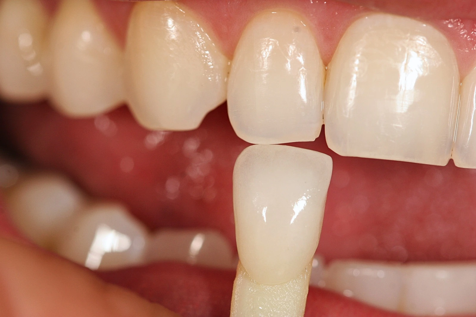 Precision Dental Restoration
